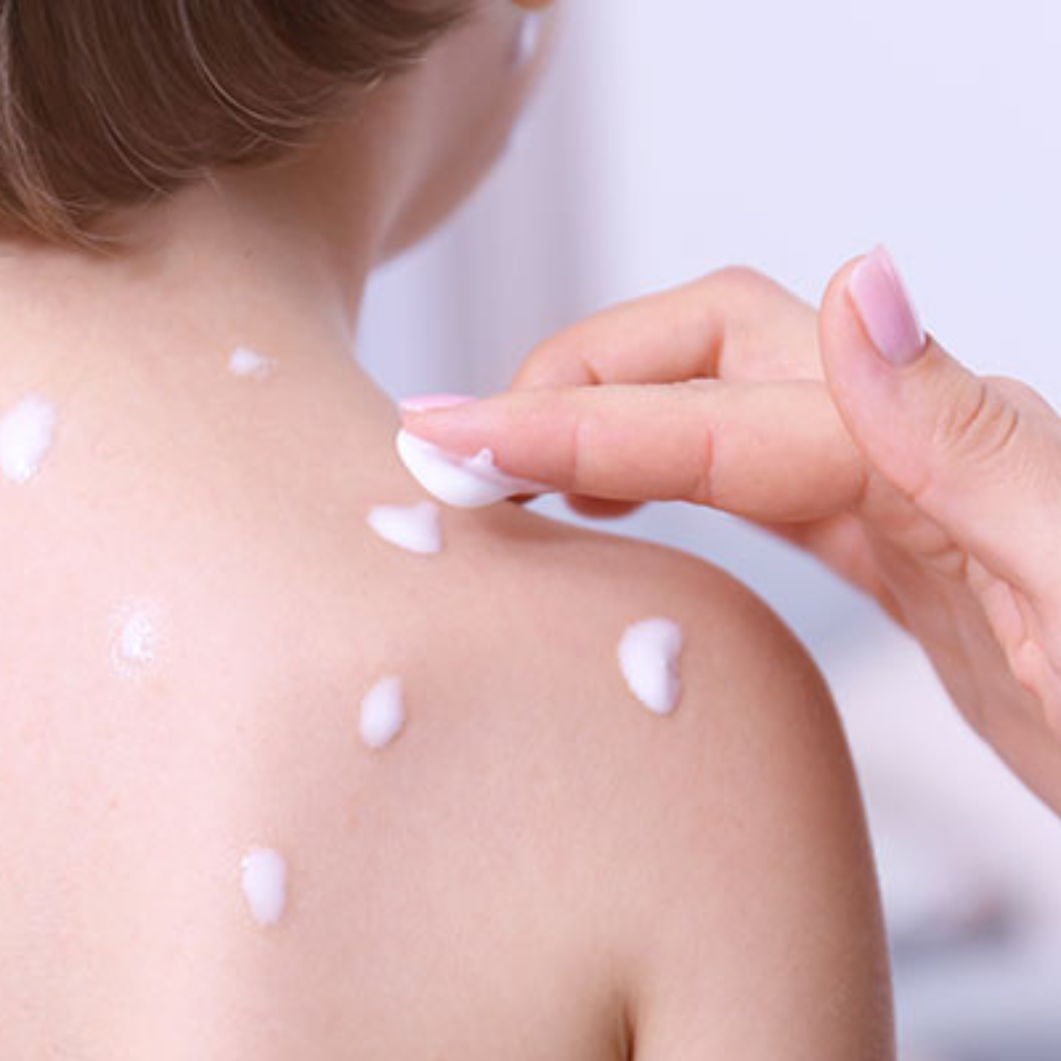 Natural remedies for Chickenpox